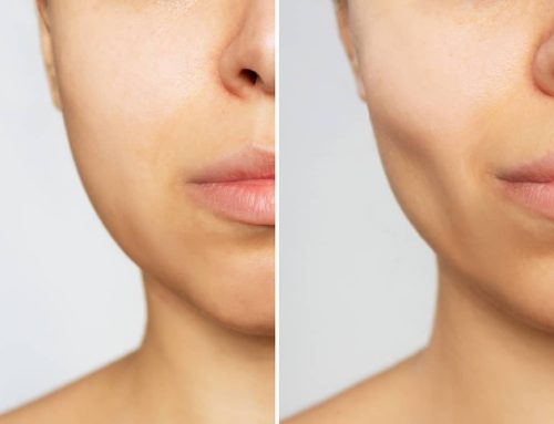 Chin or Cheek Augmentation Procedures Can Improve Your Facial Shape