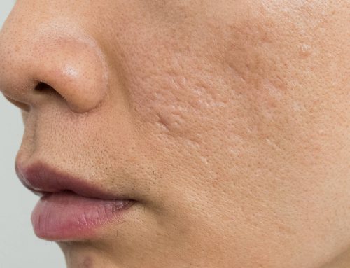 How To Treat Facial Scars: These Non-Surgical Treatments Improve Skin Texture