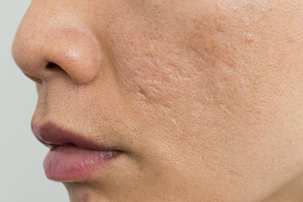 Morpheus8 RF Microneedling Fort Myers