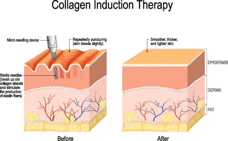 Microneedling SkinPen Fort Myers