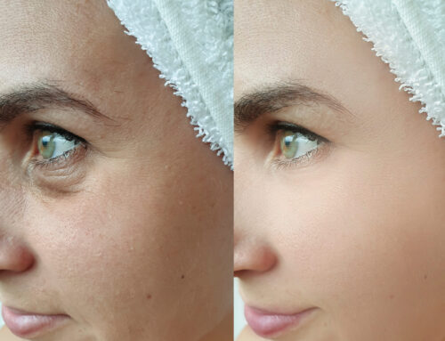 Discover the Appeal of Eyelid Surgery