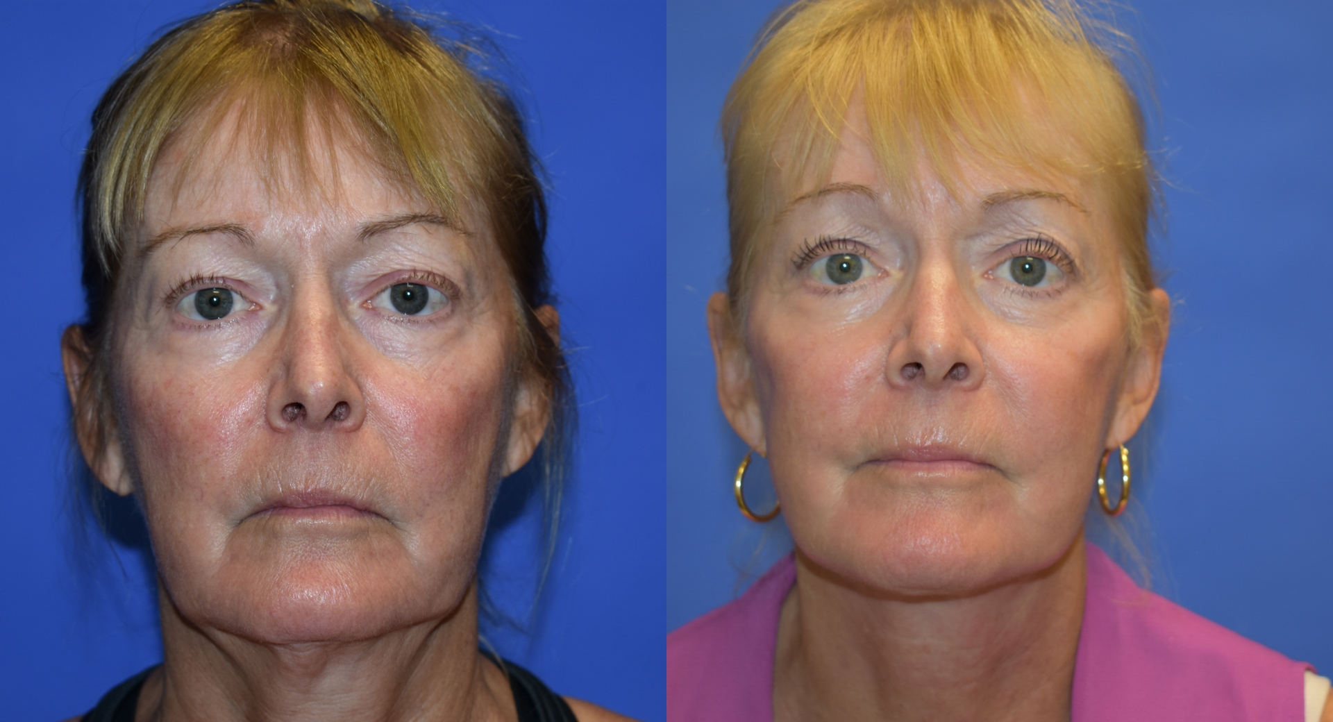 before and after photos 2