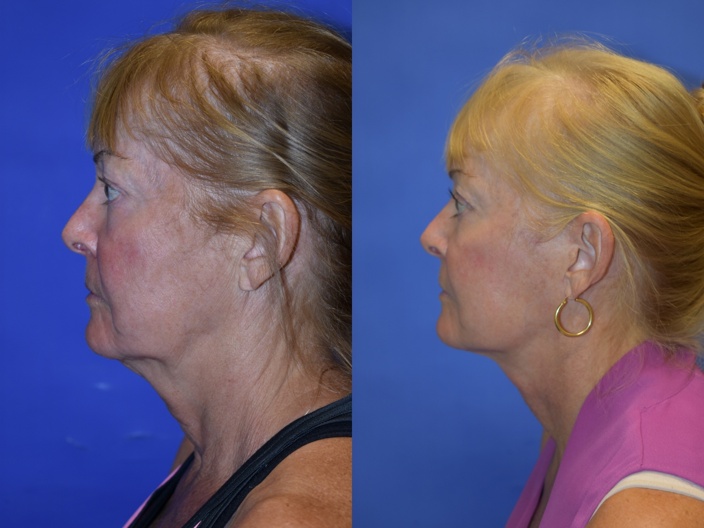 before and after photos 3