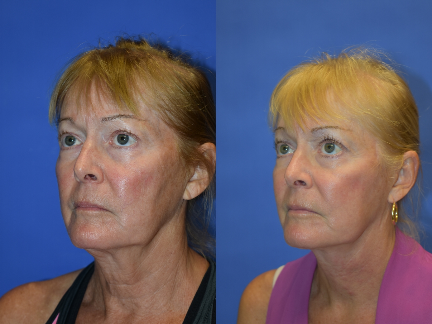 before and after photos 4